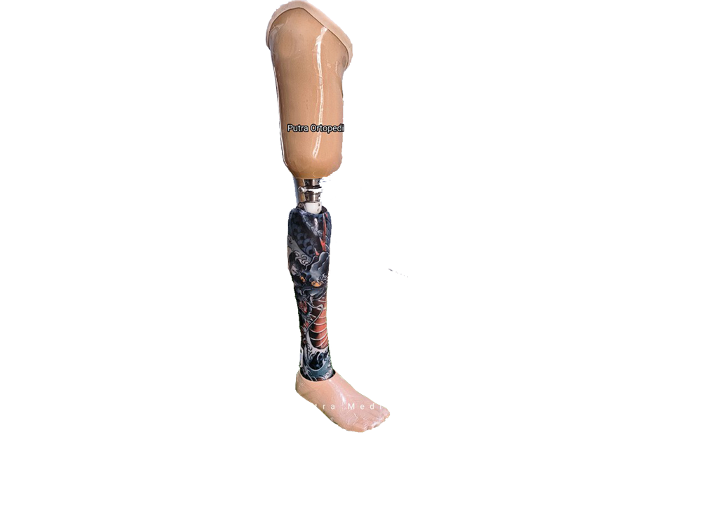 Hip Disarticulation Prosthesis